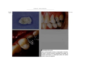 COROAS   PROVISÓRIAS




FIG 6.9G                                                                            F I G 6 .9 H
 FIG 6.91




                          FIGURAS 6.9G a 6.91
                        Após a polimerização da resina, a restauração é removida-
                        do dente, o término cervical é delimitado com grafite, os
                        excessos eliminados e a restauração polida com pedras
                        pomes e branco de espanha.
 
