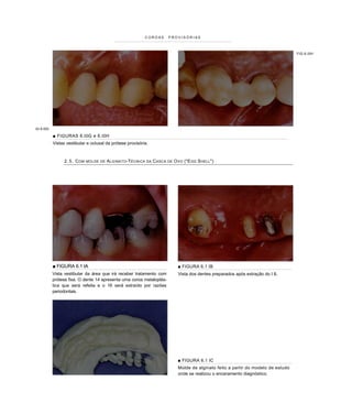 COROAS            PROVISÓRIAS



                                                                                                                                             FIG 6.I0H




IG 6.I0G

           ■ FIGURAS 6.I0G e 6.I0H
           Vistas vestibular e oclusal da prótese provisória.



                 2 . 5 . C OM   MOLDE DE   A LGINATO -T ÉCNICA   DA   C ASCA   DE   O VO ("E GG S HEL L ")




           ■ FIGURA 6.1 IA                                                            ■ FIGURA 6.1 IB
           Vista vestibular da área que irá receber tratamento com                    Vista dos dentes preparados após extração do I 6.
           prótese fixa. O dente 14 apresenta uma coroa metaloplás-
           tica que será refeita e o 16 será extraído por razões
           periodontais.




                                                                                      ■ FIGURA 6.1 IC
                                                                                      Molde de alginato feito a partir do modelo de estudo
                                                                                      onde se realizou o enceramento diagnóstico.
 