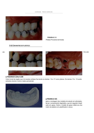 COROAS    PROVISÓRIAS




                                                                      FIGURA 6.1 II
                                                                    Prótese Provisória terminada.



             2.4) COM MATRIZ DE PLÁSTICO:



•.I2A                                                                                                                          FIG 6.I2B




        ■ FIGURAS 6.l2Ae 6.I2B
        Vista inicial da região que irá receber prótese fixa tendo os dentes 14 e 17 como pilares. Os dentes 15 e 16 serão
        extraídos devido à cárie e lesão periodontal.




                                                                   ■ FIGURA 6.12C
                                                                   Após a montagem dos modelos de estudo em articulador,
                                                                   faz-se o enceramento diagnóstico, que em seguida é dupli-
                                                                   cado em gesso. Sobre o modelo de gesso obtém-se uma
                                                                   matriz de plástico em plastificador à vácuo.
 