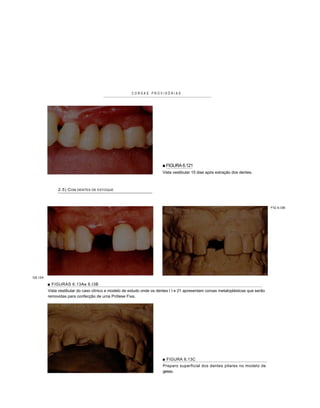 COROAS PROVISÓRIAS




                                                                       ■ FIGURA 6.121
                                                                       Vista vestibular 15 dias após extração dos dentes.



              2.5) COM DENTES DE ESTOQUE



                                                                                                                                   FIG 6.I3B




G6.I3A

         ■ FIGURAS 6.13Ae 6.I3B
         Vista vestibular do caso clínico e modelo de estudo onde os dentes I I e 21 apresentam coroas metaloplásticas que serão
         removidas para confecção de uma Prótese Fixa.




                                                                       ■ FIGURA 6.13C
                                                                        Preparo superficial dos dentes pilares no modelo de
                                                                        gesso.
 