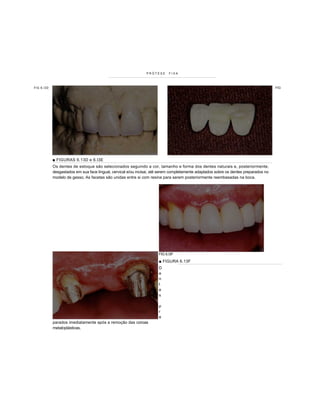 PRÓTESE      FIXA



FIG 6 .I3 D                                                                                                                             FIG




              ■ FIGURAS 6.13D e 6.I3E
              Os dentes de estoque são selecionados seguindo a cor, tamanho e forma dos dentes naturais e, posteriormente,
              desgastados em sua face lingual, cervical e/ou incisai, até serem completamente adaptados sobre os dentes preparados no
              modelo de gesso. As facetas são unidas entre si com resina para serem posteriormente reembasadas na boca.




                                                                        FIG 6.I3F
                                                                        ■ FIGURA 6.13F
                                                                        D
                                                                        e
                                                                        n
                                                                        t
                                                                        e
                                                                        s

                                                                        p
                                                                        r
                                                                        e
              parados imediatamente após a remoção das coroas
              metaloplásticas.
 