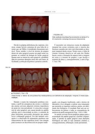 PRÓTESE   FIXA




                                                                        i FIGURA I.6C
                                                                       Vista vestibular da prótese fixa envolvendo os dentes 21 e
                                                                       23 mostrando o emprego de escova interproximal.



               Devido às próprias deficiências dos materiais e téc-        É necessário um minucioso exame da adaptação
           nicas, sempre haverá a presença de uma linha de ci-         marginal das coroas existentes, pois a maioria dos
           mento que, até 50|0m, é considerada clinicamente acei-      fracassos causados por cárie está relacionada ao desa-
           tável. Nesse sentido, o nível do término do preparo         juste marginal destas coroas. Nestes casos, a linha de
           dentro do sulco gengival assume um papel muito im-          cimento existente dissolve-se sob ação dos fluidos
           portante no controle da biologia do tecido gengival.        bucais, ocorre a formação de espaços entre a margem
           Quanto mais no interior do sulco gengival, a probabili-     da coroa e o término do preparo, o que facilita o
           dade de ocorrerem alterações nessa área será maior, di-     acúmulo de placa e, consequentemente, a cárie (Figs.
           ficultando a confecção da prótese e posterior controle.     1.7Ael.7B).


FIG I.7A




           ■ FIGURAS l . 7 A e I.7B
           Vistas frontal e lateral de uma prótese fixa metalocerâmica com deficiência de adaptação marginal, 6 meses após
           instalação.


               Durante o exame das restaurações protéticas exis-       quado, com desgaste insuficiente, onde o técnico de
           tentes, o perfil de emergência das coroas e a abertura      laboratório vê-se obrigado a realizar uma restauração
           das ameias cervicais adquirem extrema importância           que preencha os requisitos estéticos, porém, em detri-
           do ponto de vista periodontal. A coroa deve emergir         mento dos biológicos. O resultado final será um so-
           reta do sulco gengival, sem causar pressão no epitélio      brecontorno da prótese e todas as consequências da
           sulcular, pois a convexidade na área e o acúmulo de         ausência do perfil emergencial (Figs. 1.8A e 1.8B).
           placa bacteriana, provocarão ulcerações que podem               As ameias cervicais devem propiciar espaços para a
           levar à inflamação gengival. Um fato bastante corri-        acomodação das papilas gengivais e facilitar a higieni-
           queiro é a observação de restaurações protéticas com        zação. A pressão na papila gengival causa alterações
           sobrecontorno de suas superfícies axiais. Esta situação     histológicas em todas as suas estruturas celulares e,
           pode acontecer em decorrência de um preparo inade-          consequentemente, inflamação e lesão periodontal.
 