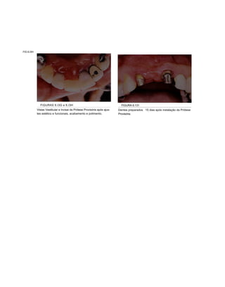 FIG 6.I3H




              FIGURAS 6.I3G e 6.I3H                                          FIGURA 6.131
            Vistas Vestibular e Incisai da Prótese Provisória após ajus-   Dentes preparados 15 dias após instalação da Prótese
            tes estético e funcionais, acabamento e polimento.             Provisória.
 