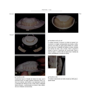 PRÓTESE    FIXA



FIG 6.I4D                                                                                                                                   FIG 6




FIG 6.I4F




                                                                            ■ FIGURAS 6.I4D a 6 . l 4 F
                                                                            O modelo encerado é incluído na mufla da maneira con-
                                                                            vencional e na região correspondente aos dentes, confec-
                                                                            ciona-se uma matriz em gesso pedra dividida em 2 partes.
                                                                            Essa matriz tem a finalidade de facilitar as várias inclusões
                                                                            das resinas de corpo, colo e incisai. Todo o conjunto é
                                                                            isolado e faz-se o vazamento da contra-mufla. Após a
                                                                            presa do gesso, a contra-mufla se separa das 2 matrizes da
                                                                            mufla, possibilitando a inclusão da resina.




            ■ FIGURA 6.I4G                                                  ■ FIGURA 6.I4H
            Inicialmente faz-se a inclusão da resina de corpo, que é        O modelo é desincluído da mufla e levado ao ASA para o
            prensada tendo um papel celofane interposto entre a re-         ajuste oclusal.
            sina e as matrizes, para facilitar a sua separação e permitir
            a colocação das resinas de colo e incisai. Após a realização
            desse processo, a polimerização da resina é feita utilizan-
            do-se os métodos convencionais.
 