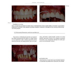 COROAS      PROVISÓRIAS




                                                                                                                                        FIG 6.I4J




FIG 6.141

              FIGURAS 6.141 e 6.I4J
            Após a remoção das provisórias do modelo, faz-se o reembasamento na boca, ajustes estético, da oclusão, do guia anterior,
            acabamento e polimento. Vista vestibular da prótese instalada e mostrando a colocação de fios e escovas interproximais
            nas ameias gengivais.



                 2.7) PROVISÓRIAS PRENSADAS COM ESTRUTURA METÁLICA



               Esta técnica é indicada para pacientes que apresen-         entes, provisórias confeccionadas somente em resina
            tam hábito parafuncional de apertar ou ranger dentes           poderão apresentar fraturas e/ou desgaste acentuado
            ou nos tratamentos onde a prótese provisória perma-            da mesma, com consequente alteração do tecido gen-
            necerá na boca por um longo período. Para esses paci-          gival e/ou da dimensão vertical.




                                                                           ■ FIGURA 6.I 5A
                                                                           Vista frontal de um caso clínico que irá receber tratamen-
                                                                           to combinado de prótese fixa e removível com encaixe.
 