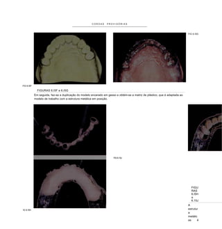 COROAS     PROVISÓRIAS



                                                                                                                                FIG 6.I5G




FIG 6.I5F

                 FIGURAS 6.I5F e 6.I5G
               Em seguida, faz-se a duplicação do modelo encerado em gesso e obtém-se a matriz de plástico, que é adaptada ao
               modelo de trabalho com a estrutura metálica em posição.




                                                                         FIG 6.15J




                                                                                                                                  FIGU
                                                                                                                                  RAS
                                                                                                                                  6.I5H
                                                                                                                                  a
                                                                                                                                  6.15J
                                                                                                                                A
:
    IG 6.I5H                                                                                                                    estrutur
                                                                                                                                a
                                                                                                                                metálic
                                                                                                                                as     é
 