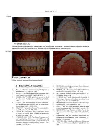 PRÓT'ESE   FIXA




FIG 6.I5K




                 FIGURAS 6.I5K e 6.I5L
            Após a polimerização da resina, os excessos são recortados e procede-se o ajuste oclusal no articulador. Observe
            pequenos contatos em metal nas faces oclusais dos pré-molares e caninos premolarizados.

FIG 6.I5M




                 FIGURAS 6.I5M e 6.I5N
            Vistas vestibular e oclusal da prótese provisória.



                    7 - BIBLIOGRAFIA CONSULTADA:                                  8.     LINDHE, J. Tratado de Periodontologia Clinica. Interameri-
                                                                                         cana, Rio de Janeiro, 1985.
            1.     AULL, A.E. Condilar determinaras of Occlusal paterns. /.       9.     McLEAN, J.W. The science and art of Dental Ceramics.
                   Prosthet. Dent. 15(15): 826-26, 1965.                                 Quintessence Publishing Co. Ltda. v. 1, 1979.
            2.     BRUGGERS, KJ. Long-term provisional restorations: Indi-        10.    MEZZOMO, E. Reabilitação Oral para o Clínico. 2a Ed.
                   cation and fabrication. QFT, 124-130, 1990/1991.                      Livraria Ed. Santos, 1994.
            3.     CHICHE, G.J.; PINAUET, A. Esthetics of Anterior Fixed          11.    NYMAN S. et ai. The role of occlusion for the stability of
                   Prosthodontics. Ia ed. Quintessence Publishing Co Ltda,               fixed bridges in patients with reduced periodontal tissue
                   1994.                                                                 support. /. Clin. Periodontal. 2:53, 1975.
            4.     COX, CF. et ai. Biocompatibility of various dental mate        12.    OKESSON, J.P. Fundamentos da Oclusão e desordens tempo-
                   riais: pulp healing with a surface seal. Int. J. Periodont.           romandibulares. 2a ed. Arte Médicas, 1992.
                   Restorat. Dent., 16(3): 241-251, 1996.                         13.    PASHLEY, E.L. et ai. Dentin permeability: sealing the dentin
            5.     DAMICO A. Functional occlusion of the natural teeth in                in crown preparations. Oper. Dent. v. 14, n. 1, p. 13-20, 1992.
                   man. / Prosthet. Dent. 11:899, 1961.                           14.    PEGORARO, L.F. et ai. Fracassos em Prótese Fixa. In: Atu-
            6.     JANSON, W et ai. Preparo de dentes com finalidade protéti-            alização na Clínica Odontologica. Artes Médicas, São Paulo,
                   ca: Técnica da silhueta. Bauru. Faculdade de Odontologia              1992.
                   de Bauru/USP Bauru, 1986.                                      15.    ROSEMBERG, M.M. et ai. Periodontal and Prosthetic Ma
            7.     LINDHE, J.; NYMAN, S. The effect of plaque control                    nagement for Advanced Cases. Ia ed. Quintessence Pu
                   and surgical pocket elimination on the stablishment and               blishing, Co Ltda, 1988.
                   maintenance of periodontal health. A longitudinal study of     16.    WISE, M.D. Failure in the Restored Dentitron: Management
                   periodontal therapy in cases of advanced disease. /. Clin.            and Treatment. Quintessence Pubhishing Co. Ltda, Ia ed.,
                   Periodont., 2:67-79, 1975.                                            1995.
 