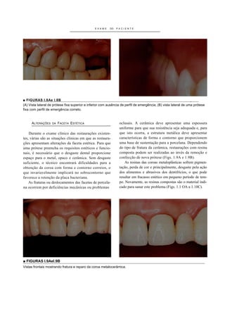 E XA ME   DO   PACIENTE




■ FIGURAS l.8Ae I.8B                                                                                               _
(A) Vista lateral de prótese fixa superior e inferior com ausência de perfil de emergência; (B) vista lateral de uma prótese
fixa com perfil de emergência correto.



     ALTERAÇÕES    DA   FACETA ESTÉTICA                          oclusais. A cerâmica deve apresentar uma espessura
                                                                 uniforme para que sua resistência seja adequada e, para
    Durante o exame clínico das restaurações existen-            que isto ocorra, a estrutura metálica deve apresentar
tes, várias são as situações clinicas em que as restaura-        características de forma e contorno que proporcionem
ções apresentam alterações da faceta estética. Para que          uma base de sustentação para a porcelana. Dependendo
uma prótese preencha os requisitos estéticos e funcio-           do tipo de fratura da cerâmica, restaurações com resina
nais, é necessário que o desgaste dental proporcione             composta podem ser realizadas ao invés da remoção e
espaço para o metal, opaco e cerâmica. Sem desgaste              confecção de nova prótese (Figs. 1.9A e 1.9B).
suficiente, o técnico encontrará dificuldades para a                As resinas das coroas metaloplásticas sofrem pigmen-
obtenção da coroa com forma e contorno correios, o               tação, perda de cor e principalmente, desgaste pela ação
que invariavelmente implicará no sobrecontorno que               dos alimentos e abrasivos dos dentifrícios, o que pode
favorece a retenção da placa bacteriana.                         resultar em fracasso estético em pequeno período de tem-
    As fraturas ou deslocamentos das facetas de porcela-         po. Novamente, as resinas compostas são o material indi-
na ocorrem por deficiências mecânicas ou problemas               cado para sanar este problema (Figs. 1.1 OA a 1.10C).




■ FIGURAS l.9Ael.9B
Vistas frontais mostrando fratura e reparo da coroa metalocerâmica.
 