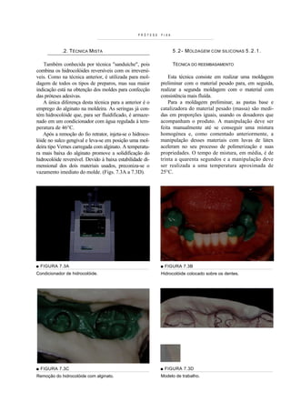 PRÓTESE   FIXA



            .2. TÉCNICA MISTA                                      5 . 2 - M OLDAGEM COM SILICONAS 5 . 2 . 1 .

    Também conhecida por técnica "sanduíche", pois                 TÉCNICA DO REEMBASAMENTO
combina os hidrocolóides reversíveis com os irreversí-
veis. Como na técnica anterior, é utilizada para mol-           Esta técnica consiste em realizar uma moldagem
dagem de todos os tipos de preparos, mas sua maior          preliminar com o material pesado para, em seguida,
indicação está na obtenção dos moldes para confecção        realizar a segunda moldagem com o material com
das próteses adesivas.                                      consistência mais fluída.
    A única diferença desta técnica para a anterior é o         Para a moldagem preliminar, as pastas base e
emprego do alginato na moldeira. As seringas já con-        catalizadora do material pesado (massa) são medi-
tém hidrocolóide que, para ser fluidificado, é armaze-      das em proporções iguais, usando os dosadores que
nado em um condicionador com água regulada à tem-           acompanham o produto. A manipulação deve ser
peratura de 46°C.                                           feita manualmente até se conseguir uma mistura
    Após a remoção do fio retrator, injeta-se o hidroco-    homogénea e, como comentado anteriormente, a
lóide no sulco gengival e leva-se em posição uma mol-       manipulação desses materiais com luvas de látex
deira tipo Vernes carregada com alginato. A temperatu-      aceleram no seu processo de polimerização e suas
ra mais baixa do alginato promove a solidificação do        propriedades. O tempo de mistura, em média, é de
hidrocolóide reversível. Devido à baixa estabilidade di-    trinta a quarenta segundos e a manipulação deve
mensional dos dois materiais usados, preconiza-se o         ser realizada a uma temperatura aproximada de
vazamento imediato do molde. (Figs. 7.3A a 7.3D).           25°C.




■ FIGURA 7.3A                                               ■ FIGURA 7.3B
Condicionador de hidrocolóide.                              Hidrocolóide colocado sobre os dentes.




■ FIGURA 7.3C                                               ■ FIGURA 7.3D
Remoção do hidrocolóide com alginato.                       Modelo de trabalho.
 
