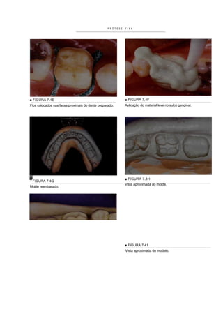 PRÓTESE   FIXA




■ FIGURA 7.4E                                               ■ FIGURA 7.4F
Fios colocados nas faces proximais do dente preparado.      Aplicação do material leve no sulco gengival.




                                                            ■ FIGURA 7.4H
 FIGURA 7.4G
                                                            Vista aproximada do molde.
Molde reembasado.




                                                            ■ FIGURA 7.41
                                                            Vista aproximada do modelo.
 