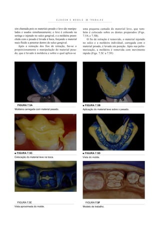 O L D A C E M   E   M O D E L O     DE   T R A B A L H O



sim chamada pois os materiais pesado e leve são manipu-                 uma pequena camada do material leve, que tam-
lados e usados simultaneamente; o leve é colocado na                    bém é colocado sobre os dentes preparados (Figs.
seringa e injetado no sulco gengival, e a moldeira preen-               7.5A e 7.5B).
chida com o pesado é levada à boca, forçando o material                    O fio de retração é removido, o material injetado
mais fluído a penetrar dentro do sulco gengival.                        no sulco e a moldeira individual, carregada com o
    Após a remoção dos fios de retração, faz-se o                       material pesado, é levada em posição. Após sua polin-
proporcionamento e manipulação do material pesa-                        merização, a moldeira é removida com movimento
do, que é levado à moldeira e sobre o qual aplica-se                    rápido (Figs. 7.5C a 7.5F)




  FIGURA 7.5A                                                       ■ FIGURA 7.5B
Moldeira carregada com material pesado.                             Aplicação do material leve sobre o pesado.




■ FIGURA 7.5C                                                       ■ FIGURA 7.5D
Colocação do material leve na boca.                                 Vista do molde.




  FIGURA 7.5E                                                             FIGURA 7.5F
Vista aproximada do molde.                                              Modelo de trabalho.
 