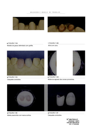 M O L D A G E M   E   MOD ELO     DE   T R A B A L H O




■ FIGURA 7.6A                                                      I FIGURA 7.6B
Modelo de gesso delimitado com grafite.                            Alívio em cera.




■ FIGURA 7.6C                                                      ■ F IGURA 7.6D
Casquetes concluídos.                                              Molde de alginato das coroas provisórias.




■ FIGURA 7.6E                                                      ■ FIGURA 7.6F
Molde preenchido com resina acrílica.                              Casquetes concluídos.

                                                                                                Dr fi ANA PAULA C.
                                                                                                  CIRURGIÃ DENTI
                                                                                                CRO-AM 1698-CRO-Si
                                                                                                   CIC 171838368
 