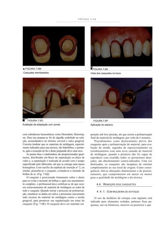 PRÓTESE   FIXA




■ FIGURA 7.6M                                                    FIGURA 7.6N
Casquetes reembasados.                                          Vista dos casquetes na boca




    FIGURA 7.6O                                                   FIGURA 7.6P
Avaliação da adaptação com sonda.                               Aplicação do adesivo.


com substâncias hemostáticas como Hemodent, Hemotop,            posição sob leve pressão, até que ocorra a polimerização
etc. Para isso prepara-se fio de algodão embebido na solu-      final do material de moldagem, por volta de 6 minutos.
ção, acomodando-o no término cervical e sulco gengival.             Procedimentos como deslocamento prévio dos
Convém lembrar que os materiais de moldagem, especial-          casquetes após a polimerização do material, para ava-
mente indicados para esta técnica, são hidrófobos, e portan-    liação do molde, seguidos de reposicionamento ou
to, após a remoção do fio o dente preparado deve estar seco.    reembasamento com uma nova camada de material
    As pastas base e catalizadora são proporcionadas igual-     de moldagem, quando a primeira não foi capaz de
mente, distribuídas em bloco de espatulação ou placa de         reproduzir com exatidão todos os pormenores dese-
vidro e, a espatulação é realizada de acordo com o tempo        jados, são absolutamente contra-indicados. Uma vez
especificado pelo fabricante, até que se consiga uma massa      deslocados, os casquetes são incapazes de retornar
homogénea. Com auxílio da espátula de inserção n° 2, ou         completamente ao seu local de origem. Como conse-
similar, preenche-se o casquete, evitando-se a inclusão de      quência, têm-se alterações dimensionais e de posicio-
bolhas de ar. (Fig. 7.6Q)                                       namento, que comprometem em maior ou menor
     O casquete é posicionado lentamente sobre o dente          grau a qualidade da moldagem e da técnica.
para se evitar a inclusão de bolhas e, após seu assentamen-
to completo, o profissional deve certificar-se de que ocor-            4.4 . R EMOÇÃO   DOS CASQUETES
reu extravasamento do material de moldagem ao redor de
todo o casquete. Quando iniciar o processo de polimeriza-              4 . 4 . 1 . COM MOLDEIRA DE ESTOQUE
ção, umedecer os dedos em saliva e pressionar suavemente
todo excesso do material de moldagem contra o tecido               O uso da moldeira de estoque com alginato está
gengival, para promover sua regularização em torno do           indicado para elementos isolados, próteses fixas pe-
casquete (Fig. 7.6R). O casquete deve ser mantido em            quenas, uni ou bilaterais, anterior ou posterior e que
 