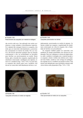 M O L D A G E M   E   M O D E L O     DE   T R A B A L H O




■ FIGURA 7.6Q                                                          ■ FIGURA 7.6R
Preenchimento dos casquetes com material de moldagem.                  Casquetes posicionados nos dentes.


não envolva todo arco. Sua aplicação tem razões eco-                   dadosamente, posicionados no molde de alginato. As
nómicas e exige cuidados e procedimentos especiais.                    facetas criadas nos casquete e regularização do elastô-
Se o alginato não conseguir remover os casquetes, eles                 mero extravasado em volta do casquete, têm a finali-
terão que ser removidos individualmente e, posiciona-                  dade de facilitar esse procedimento.
dos corretamente no interior do molde. Por esse mo-                        Os casquetes também podem ser removidos com
tivo, não devem apresentar qualquer tipo de retenção                   moldeiras de estoque preenchidas com silicona de con-
externamente e sim, ser arredondados ou facetados                      densação. Para isso, emprega-se a técnica da dupla mistu-
para facilitar seu posicionamento no molde. Desta                      ra, onde a moldeira é carregada com o material pesado e
forma, após a inserção dos casquetes, regularização do                 os casquetes e dentes vizinhos são cobertos com o mate-
elastômero extravazado e moldagem com alginato, re-                    rial mais fluído, usando-se uma seringa de moldagem.
move-se a moldeira (Figs. 7.6S a 7.6U). Se nesta fase,                 Em seguida leva-se a moldeira em posição na boca. Esta
os casquetes não saírem junto com a moldeira, eles                     técnica está indicada para casos de próteses extensas onde
devem ser removidos individualmente da boca e cui-                     vários dentes estão preparados (Figs. 7.6V e 7.6X).




M FIGURA 7.6S                                                          ■ FIGURA 7.6T
Casquetes removidos no molde com alginato.                             Vista aproximada do molde com os casquetes.
 