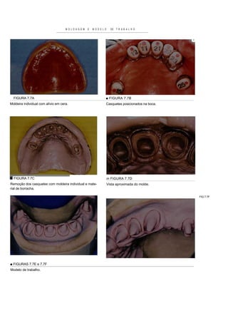 M O L D A G E M   E   M O D E L O     DE   T R A B A L H O



                                                                                                       ^




  FIGURA 7.7A                                                        ■ FIGURA 7.7B
Moldeira individual com alívio em cera.                              Casquetes posicionados na boca.




  FIGURA 7.7C                                                            m FIGURA 7.7D
Remoção dos casquetes com moldeira individual e mate-                    Vista aproximada do molde.
rial de borracha.

                                                                                                           FIG 7.7F




■ FIGURAS 7.7E e 7.7F
Modelo de trabalho.
 