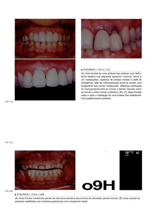 ■ FIGURAS I . I I A a I . I I C
                                                                         (A) Vista frontal de uma prótese fixa anterior com defici-
                                                                         ência estética nos seguintes aspectos: contorno, forma e
                                                                         cor inadequados, ausência de ameias incisais e perfil de
                                                                         emergência, falta de individualização entre as coroas, eixo
                                                                         longitudinal das coroas inadequado, diferença acentuada
                                                                         do nível gengival entre as coroas e dentes naturais; entre
                                                                         as coroas e entre coroas e pônticos; (B); (C) vistas frontais
                                                                         antes e após a instalação de uma prótese fixa metalocerâ-
                                                                         mica esteticamente aceitável.
FIG I.II A




FIG I.IIC




                                                                                                   -
                                                                                                                     lá**! x|
                                                                                                                     '■JÊp




FIG I.I2A
             ■ FIGURAS l . l 2 A e I.I2B
                                                                          o9H
             (A) Vista frontal mostrando perda de estrutura dentária decorrente de atividade parafuncional; (B) vista oclusal do
             paciente reabilitado com próteses posteriores com oclusal em metal.
 