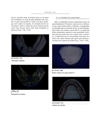 PRÓTESE FIXA



inicial, retenções feitas do próprio gesso ou de metal         5 . 1 .4. VAZAMENTO DO CESSO PEDRA
(fio ortodôntico ou clips de papel dobrados) são fixa-
dos no gesso para permitir a união com gesso pedra,          Após a cristalização do gesso especial,que ocorre em
que será vazado em seguida. As retenções devem ser       aproximadamente 30 minutos, removem-se os alfinetes,
colocadas à distai e mesial dos pinos metálicos,assim    e caso o gesso tenha coberto os alfinetes, as irregularida-
como entre eles,nos locais onde serão esculpidos os      des deixadas após sua remoção devem ser uniformizadas.
pônticos (Figs. 7.8E e 7.8F).                            Após isolar com vaselina o gesso tipo IV, na região dos
                                                         dentes preparados espatula-se uma quantidade sufici-
                                                         ente de gesso pedra que será vazado sobre o primei-
                                                         ro. É importante que as extremidades dos pinos me-
                                                         tálicos não sejam cobertas pelo gesso para facilitar a
                                                         remoção dos troqueis do modelo Figs. 7.8G e 7.8H).




■ FIGURA 7.8E
Retenções metálicas




                                                         ■ FIGURA 7.8G
                                                         Molde vazado com gesso pedra IV




i FIGUPL^ 7;8F
Retenções com gesso




                                                         ■ FIGURA 7.8H
                                                         Modelo de trabalho.
 
