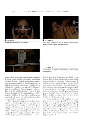 R E G I S T R O S   O C L U S A I S   E   MONTAGEM   EM   ARTICULADORES         SEMI-AJUSTAVEIS




 FIGURA 8.2A                                                            FIGURA 8.2B
Vista frontal do arco facial em posição.                              Vista lateral mostrando a oliva de plástico posicionada no
                                                                      meato auditivo externo e relator nasion.




                                                                        FIGURA 8.2C
                                                                      Visualização da distância intercondilar no ramo anterior
                                                                      do arco facial.



los das ATMs, apresentam três posições de montagem                    fuso do arco facial. O conjunto arco facial e ramo
de acordo com a distância intercondilar determinada                   superior do articulado r fica apoiado na mesa inci sai
pelo arco. O ajuste é realizado acrescentando-se espa-                do ramo inferior do articulador. Para a montagem do
çadores nas guias condilares: sem espaçador para a                    modelo superior, o pino incisai deve ser removido do
distância intercondilar pequena, um espaçador para a                  ramo superior do articulador. O modelo de gesso é
média e dois espaçadores para a grande. A face chan-                  posicionado nas impressões de godiva criadas no garfo
frada do espaçador deve ficar voltada para a guia con-                e, para se evitar-se o movimento vertical do mesmo,
dilar. Nessa fase a inclinação ântero-posterior da guia               utiliza-se um acessório chamado guia telescópico ex-
deve ser ajustada em 30° e o ângulo de Benett em 15°.                 pansivo (balança) para dar sustentação ao modelo.
Os postes condilares do ramo inferior também devem                    Pode-se também usar gesso interposto entre a base
ser ajustados de acordo com a distância intercondilar                 inferior do articulador e o garfo.
já determinada no ramo superior.                                            Para a fixação do modelo na placa de monta-
      Com a placa de montagem parafusada no ramo                      gem, usa-se uma pequena quantidade de gesso espe-
superior do articulador, posiciona-se o arco facial com               cial que após sua presa, faz-se a complementação da
uma das mãos contra o corpo do articulador, que é                     montagem com gesso pedra. Aguarda-se a presa do
segurado pela o utra mão, encaixando-se os pinos                      mesmo, remove-se cuidadosamente o arco facial do
situados nas faces externas das guias condilares nos                  articulador e coloca-se o pino incisai com sua extre-
orifícios existentes nas olivas de plástico. O arco deve              midade arredondada em contato com a mesa incisai
ser apoiado contra o corpo do operador. Introduz-se                   para manter o ramo superior contra o ramo inferior.
primeiro um pino, depois o outro e aperta-se o para-                  (Figs. 8.3A a 8.3D)
 