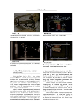 PRÓTESE   FIXA




  FIGURA 8.3A                                                  FIGURA 8.3B
Arco facial e ramo superior do articulador posicionados      Posicionamento do arco facial no articulador
contra o corpo do operador




  FIGURA 8.3C
                                                               FIGURA 8.3D
Guia telescópico expansivo (balança) para dar sustentação
ao modelo.                                                   Modelo superior fixado no ASA. O ramo superior é man-
                                                             tido paralelo ao inferior através do pino incial.


     4 . 1 . 2 . MONTAGEM DO MODELO INFERIOR-                no ligamento periodontal, e assim, tornar mais fácil a
     REGISTRO DA RC                                          manipulação da mandíbula em relação cêntrica. Aconse-
                                                             lha-se isolar os dentes com vaselina ou adaptar papel
      Como a relação cêntrica (R.C.) é uma posição           alumínio nos dentes envolvidos para evitar que a resina
craniomandibular e, portanto, independe da presença          adira aos mesmos. A resina deve ser colocada sobre os
de dentes para sua determinação, o registro dessa po-        dentes ainda plástica e manipula-se a mandíbula na posi-
sição deve ser obtido com os dentes separados o míni-        ção de R.C. durante sua polimerização.
mo possível, para compensar a primeira limitação do                Durante essa fase deve-se ter cuidado com a rea-
ASA, que é a impossibilidade de se transferir para o         ção exotérmica da resina que pode lesionar o tecido
articulador o eixo de rotação presente nos côndilos,         gengival. Após o acabamento, o JIG deve apresentar
como comentado anteriormente.                                estabilidade e apenas um ponto de contato com um
      Para facilitar este procedimento, confecciona-se um    dos dentes antagonistas, permitindo a mínima separa-
dispositivo com resina acrílica ativada quimicamente di-     ção dos dentes posteriores.
retamente na boca, envolvendo os incisivos centrais su-            Outro método também empregado para despro-
periores e estendendo-a, aproximadamente, 2cm em di-         gramar a mandíbula é o de "Long", que consiste em
reção palatina. Este dispositivo é conhecido como Guia       colocar entre os incisivos centrais tiras "calibradoras"
de Interferência Oclusal (JIG), e tem como objetivo des-     de plástico, em número suficiente, para causar a sepa-
programar a memória dos mecanoreceptores localizados         ração dos dentes posteriores.
 