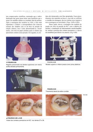 R E G I S T R O S   O C L U S A I S   E   M O N T A G E M   EM   A R T I C U L A D O R E S   S E M I - A J U S T A V E I S



tem comprovações científicas, mostrando que a indivi-                        tatos são demarcados com fitas apropriadas. Esses proce-
dualização das guias possa trazer mais benefícios que o                      dimentos são repetidos na boca e, caso não se confirme
ajuste em medidas médias no resultado final da prótese.                      a exatidão da montagem, deve-se realizar novo registro e
Após a montagem dos modelos no ASA, a fase mais                              nova montagem no articulador. (Figs. 8.6D a 8.6G)
importante é conferir a correspondência dos conta-tos                               Desse modo, tem-se a montagem dos modelos de
oclusais dos modelos com os da boca na posição de                            estudo em ASA na posição de R.C. com o objetivo de
relação cêntrica, Isso é feito determinando-se, inicial-                     facilitar a visualização do relacionamento maxilo/mandibu-
mente, com tiras de papel celofane quais os dentes que                       lar, analisar a presença dos contatos prematuros e o desvio
apresentam contatos nessa posição. Em seguida, os con-                       da mandíbula para lateral e/ou anterior. (Fig. 8.6H)




W FIGURA 8.6A                                                                    FIGURA 8.6B
Registro posicionado nos dentes superiores com resina                        Modelo superior e inferior presos como pinos plásticos.
acrílica ativada quimicamente.




                                                                                 FIGURA 8.6C
                                                                             Travamento lateral da esfera condilar

                                                                                                                                           FIG 8.6E




■ FIGURAS 8.6D e 8.6E
Vistas dos contatos prematuros em KC. nos dentes 27 e 36.
 