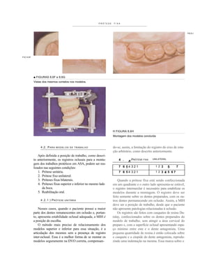 PRÓTESE   FIXA




                                                                                                                                 FIG 8.<




FIG 8.6F




           ■ FIGURAS 8.6F e 8.6G
           Vistas dos mesmos contatos nos modelos.




                                                                      H FIGURA 8.6H
                                                                      Montagem dos modelos concluída



                4.2. PARA    MODELOS DE TRABALHO                      do-se, assim, a limitação do registro do eixo de rota-
                                                                      ção arbitrário, como descrito anteriormente.
               Após definida a posição de trabalho, como descri-
           to anteriormente, os registros oclusais para a monta-          4 .    PRÓTESE FIXA        UNILATERAL

           gem dos trabalhos protéticos em ASA, podem ser rea-              2     n
           lizados nas seguintes condições:                               7 6 54 3 2 1                 1 2 3      5     7
               1. Prótese unitária.                                       7 6 54 321                   1 2 3   4 5 67
               2. Prótese fixa unilateral.
               3. Próteses fixas bilaterais.                              Quando a prótese fixa está sendo confeccionada
               4. Próteses fixas superior e inferior no mesmo lado    em um quadrante e o outro lado apresenta-se estável,
                  da boca.                                            o registro intermaxilar é necessário para estabilizar os
               5. Reabilitação oral.                                  modelos durante a montagem. O registro deve ser
                                                                      feito somente sobre os dentes preparados, com os ou-
                4 . 2 . 1 ) P RÓTESE   UNITÁRIA                       tros dentes permanecendo em oclusão. Assim, a MIH
                                                                      deve ser a posição de trabalho, desde que o paciente
               Nesses casos, quando o paciente possui a maior         não apresente patologias relacionadas à oclusão.
           parte dos dentes remanescentes em oclusão e, portan-           Os registros são feitos com casquetes de resina Du-
           to, apresenta estabilidade oclusal adequada, a MIH é       ralay, confeccionados sobre os dentes preparados do
           a posição de escolha.                                      modelo de trabalho, sem atingir a área cervical do
               O método mais preciso de relacionamento dos            preparo e, com a superfície oclusal apresentando espa-
           modelos superior e inferior para essa situação, é a        ço mínimo entre este e o dente antagonista. Uma
           articulação dos mesmos sem a presença de registro          pequena quantidade de resina é então colocada sobre
           inter-oclusal. Essa é a melhor forma de se montar os       o casquete e a cúspide do dente antagonista, reprodu-
           modelos seguramente na DVO correta, compensan-             zindo uma indentação na mesma. Essa marca sobre o
 