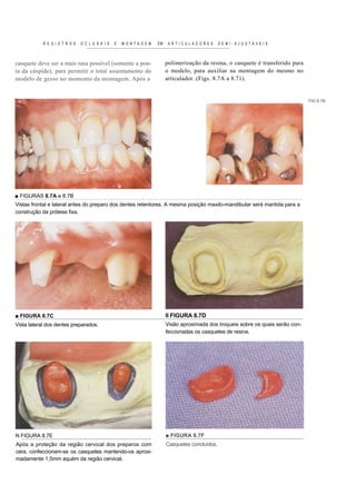 R E G I S T R O S   O C L U S A I S   E   M O N TA G EM   EM    ARTICULADORES          SEMI-AJUSTÁVEIS



casquete deve ser a mais rasa possível (somente a pon-                     polimerização da resina, o casquete é transferido para
ta da cúspide), para permitir o total assentamento do                      o modelo, para auxiliar na montagem do mesmo no
modelo de gesso no momento da montagem. Após a                             articulador. (Figs. 8.7A a 8.71).


                                                                                                                                     FIG 8.7B




■ FIGURAS 8.7A e 8.7B
Vistas frontal e lateral antes do preparo dos dentes retentores. A mesma posição maxilo-mandibular será mantida para a
construção da prótese fixa.




■ FIGURA 8.7C                                                              II FIGURA 8.7D
Vista lateral dos dentes preparados.                                       Visão aproximada dos troqueis sobre os quais serão con-
                                                                           feccionadas os casquetes de resina.




N FIGURA 8.7E                                                              ■ FIGURA 8.7F
Após a proteção da região cervical dos preparos com                        Casquetes concluídos.
cera, confeccionam-se os casquetes mantendo-os aproxi-
madamente 1,5mm aquém da região cervical.
 