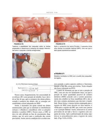 PRÓTESE   FIXA




  FIGURA 8.7G                                                FIGURA 8.7H
Testa-se a estabilidade dos casquetes sobre os dentes      Após o acréscimo de resina Duralay, o paciente oclue
preparados e observa-se a presença de espaço interoclu-    seus dentes na posição habitual (MIH), uma vez que o
sal entre o casquete e dentes antagonistas.                lado oposto apresenta-se estável.




                                                           ■ FIGURA 8.71
                                                           Modelos montados no ASA com o auxilio dos casquetes
                                                           de registro.



     4 . 2 . 5 ) PRÓTESES FIXAS BILATERAIS:                nova posição e outros aspectos estéticos e funcionais,
                                                           durante a fase das coroas provisórias. Nesta situação
        76 5 4 3 2 1 1 2 3 4 5 67                          não houve alteração na DVO.
             5 4 3 2 1 12 3 4 5 7                             A partir do momento em que se tem a posição de
                                                           ORC, com um arco de fechamento único, na qual a
   Nesses casos, frequentemente, há a necessidade de       posição de maior quantidade possível de contatos
se utilizar a RC como posição de trabalho. Isso é devi-    dentários (MIH) coincide com o correto posiciona-
do ao fato de que, após os preparos dos dentes pilares,    mento dos côndilos na fossa mandibular (RC), não se
somado à ausência dos dentes, não se consegue um           têm mais contatos prematuros que desviam a mandí-
estabilidade oclusal adequada em MIH.                      bula. Dessa forma, a mesma técnica empregada para o
   Assim, é necessário um ajuste oclusal nos dentes        registro de MIH como descrito no item anterior, é
remanescentes, para que se eliminem as interferências      válida para o registro da ORC que, neste caso, passou
oclusais e obtenha-se coincidência entre as posições       a ser a posição habitual. Assim, removem-se as coroas
dentária e condilar (ORC). Nesses casos, a ORC já          provisórias de um lado e faz-se o registros com cas-
deve ter sido definida na fase de enceramento diag-        quetes de resina. Após a polimerização da resina, repe-
nóstico, que irá servir para a confecção das coroas        tem-se os procedimentos para o registro do outro
provisórias. Assim, tem-se condições de se avaliar essa    lado. (Figs. 8.8A a 8.8X).
 