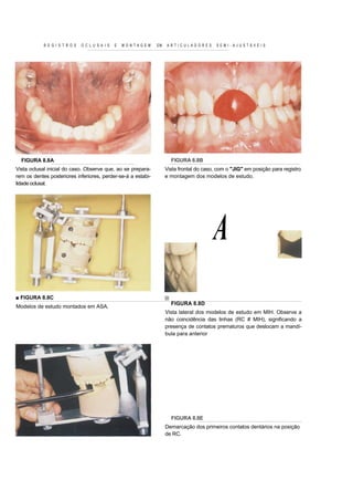 R E G I S T R O S   O C L U S A I S   E   MONTAGEM   EM   ARTICULADORES         SEMI-AJUSTÁVEIS




  FIGURA 8.8A                                                           FIGURA 8.8B
Vista oclusal inicial do caso. Observe que, ao se prepara-            Vista frontal do caso, com o "JIG" em posição para registro
rem os dentes posteriores inferiores, perder-se-á a estabi-           e montagem dos modelos de estudo.
lidade oclusal.




                                                                                           A
■ FIGURA 8.8C
                                                                        FIGURA 8.8D
Modelos de estudo montados em ASA.
                                                                      Vista lateral dos modelos de estudo em MIH. Observe a
                                                                      não coincidência das linhas (RC # MIH), significando a
                                                                      presença de contatos prematuros que deslocam a mandí-
                                                                      bula para anterior




                                                                        FIGURA 8.8E
                                                                      Demarcação dos primeiros contatos dentários na posição
                                                                      de RC.
 
