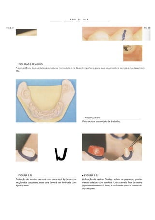 PRÓTESE   FIXA




FIG 8.8F




             FIGURAS 8.8F e 8.8G
           A coincidência dos contatos prematuros no modelo e na boca é importante para que se considere correta a montagem em
           RC.




                                                                         FIGURA 8.8H
                                                                       Vista oclusal do modelo de trabalho.




                                             J
             FIGURA 8.81                                               ■ FIGURA 8.8J
           Proteção do término cervical com cera azul. Após a con-     Aplicação de resina Duralay sobre os preparos, previa-
           fecção dos casquetes, essa cera deverá ser eliminada com    mente isolados com vaselina. Uma camada fina de resina
           água quente.                                                (aproximadamente 0,3mm) é suficiente para a confecção
                                                                       do casquete.
 