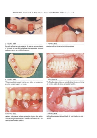 REGISTROS      OCLUSAIS      E   MONTAGEM       EM A R T I C U L A D O R E S   SEMI-AJUSTÁVEIS




■ FIGURA 8.8K                                                  ■ FIGURA 8.8L
Durante a fase de polimerização da resina, recomenda-se        Acabamento e refinamento dos casquetes.
a remoção e inserção cuidadosa dos casquetes, para se
evitarem danos ao modelo de gesso.




■ FIGURA 8.8M                                                     FIGURA 8.8N
Vista oclusal do modelo inferior com todos os casquetes        Verificação da precisão da oclusão da prótese provisória
prontos para o registro na boca.                               de um dos lados da boca, antes do registro.




  FIGURA 8.8O                                                  ■ FIGURA 8.8P
Após a retirada da prótese provisória de um dos lados,         Aplicação de pequena quantidade de resina sobre os cas-
colocam-se os casquetes em posição, verificando-se o es-       quetes.
paço oclusal para o registro.
 