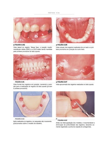 PRÓTESE   FIXA




■ FIGURA 8.8Q                                                ■ FIGURA 8.8R
Vista lateral do registro. Nessa fase, a posição maxilo-     Vista oclusal, dos registros realizados de um lado e a pró-
mandibular obtida (ORC) e a DVO estão sendo mantidas         tese provisória em posição do outro lado.
pela prótese provisória do lado oposto.




  FIGURA 8.8S                                                ■ FIGURA 8.8T
Vista frontal dos registros em posição, mantendo a posi-     Vista aproximada dos registros realizados no lado oposto.
ção para a realização do registro do lado oposto (já sem
a prótese provisória).




  FIGURA 8.8U
                                                               FIGURA 8.8V
Após realizados os registros, os casquetes são novamente
posicionados sobre o modelo de trabalho.                     Antes da intercuspidação dos modelos, é recomendável a
                                                             diminuição da profundidade dos registros, deixando so-
                                                             mente registrada a ponta de cúspide do antagonista.
 