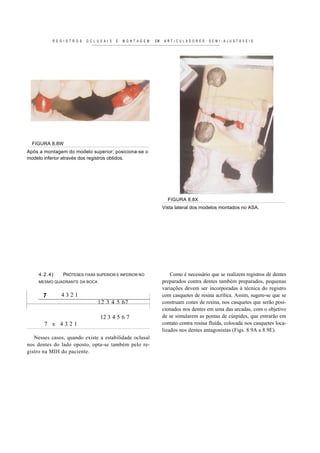 R E G I S T R O S   O C L U S A I S   E   M O N T A G E M   EM    ARTICULADORES       SEMI-AJUSTÁVEIS




  FIGURA 8.8W
Após a montagem do modelo superior; posiciona-se o
modelo inferior através dos registros obtidos.




                                                                              FIGURA 8.8X
                                                                            Vista lateral dos modelos montados no ASA.




     4.2.4)      PRÓTESES FIXAS SUPERIOR E INFERIOR NO                          Como é necessário que se realizem registros de dentes
     MESMO QUADRANTE DA BOCA                                                preparados contra dentes também preparados, pequenas
                                                                            variações devem ser incorporadas à técnica do registro
       7        4321                                                        com casquetes de resina acrílica. Assim, sugere-se que se
                                     12 3 4 5 67                            construam cones de resina, nos casquetes que serão posi-
                                                                            cionados nos dentes em uma das arcadas, com o objetivo
                                       12 3 4 5 6 7                         de se simularem as pontas de cúspides, que entrarão em
       7 x 4321                                                             contato contra resina fluída, colocada nos casquetes loca-
                                                                            lizados nos dentes antagonistas (Figs. 8.9A a 8.9E).
   Nesses casos, quando existe a estabilidade oclusal
nos dentes do lado oposto, opta-se também pelo re-
gistro na MIH do paciente.
 