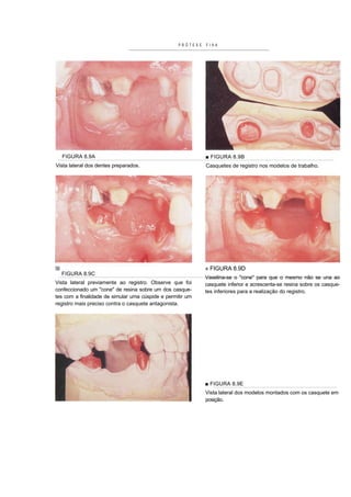 PRÓTESE   FIXA




  FIGURA 8.9A                                                ■ FIGURA 8.9B
Vista lateral dos dentes preparados.                         Casquetes de registro nos modelos de trabalho.




                                                             « FIGURA 8.9D
  FIGURA 8.9C
                                                             Vaselina-se o "cone" para que o mesmo não se una ao
Vista lateral previamente ao registro. Observe que foi       casquete inferior e acrescenta-se resina sobre os casque-
confeccionado um "cone" de resina sobre um dos casque-       tes inferiores para a realização do registro.
tes com a finalidade de simular uma cúspide e permitir um
registro mais preciso contra o casquete antagonista.




                                                             ■ FIGURA 8.9E
                                                             Vista lateral dos modelos montados com os casquete em
                                                             posição.
 