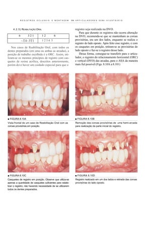 REGISTROS        OCLUSAIS      E   MONTAGEM       EM   ARTI CUL ADO RES     SEMI -A1 USTÁ VEI S




     4 . 2 . 5 ) REABILITAÇÃO ORAL                                registro seja realizado na DVO.
                                                                     Para que durante os registros não ocorra alteração
          6        321               12       6                   na DVO, recomenda-se que se mantenham as coroas
              ~T4~3T1                1234 5                       provisórias, era um dos lados, enquanto se realiza o
                                                                  registro do lado oposto. Após feito esse registro, e com
   Nos casos de Reabilitação Oral, com todos os                   os casquetes em posição, retiram-se as provisórias do
dentes preparados (em uma ou ambas as arcadas), a                 lado oposto e faz-se o registro desse lado.
posição de trabalho escolhida é a ORC. Assim, uti-                   Dessa forma, consegue-se transferir para o articu-
lizam-se os mesmos princípios de registro com cas-                lador, o registro do relacionamento horizontal (ORC)
quetes de resina acrílica, descritos anteriormente,               e vertical (DVO) das arcadas, para o ASA da maneira
porém deve haver um cuidado especial para que o                   mais fiel possível (Figs. 8.10A a 8.101)




■ FIGURA 8.10A                                                    ■ FIGURA 8.10B
Vista frontal de um caso de Reabilitação Oral com as              Remoção das coroas provisórias de uma hemi-arcada
coroas provisórias em posição.                                    para realização da parte inicial do registro.




■ FIGURA 8.10C                                                    ■ FIGURA 8.10D
Casquetes de registro em posição. Observe que utiliza-se          Registro realizado em um dos lados e retirada das coroas
apenas a quantidade de casquetes suficientes para estabi-         provisórias do lado oposto.
lizar o registro, não havendo necessidade de se utilizarem
todos os dentes preparados.
 