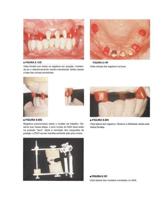 ■ FIGURA 8. IOE                                               FIGURA 8.10F
Vista frontal com todos os registros em posição, manten-    Vista oclusal dos registros na boca.
do-se o relacionamento maxilo-mandibular obtido desde
a fase das coroas provisórias.




■ FIGURA 8.I0G                                              ■ FIGURA 8.I0H
Registros posicionados sobre o modelo de trabalho. Ob-      Vista lateral dos registros. Observe a fidelidade obtida pela
serve que nessa etapa, o pino incisai do ASA deve estar     resina Duralay.
na posição "zero". Após a remoção dos casquetes de
posição, a DVO vai ser mantida somente pelo pino incisai.




                                                            ■ FIGURA 8.101
                                                            Vista lateral dos modelos montados no ASA.
 