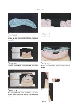 PRÓTESE   FIXA




                                                               ■ FIGURA 8.1 IF
  FIGURA 8.1 IE
                                                               Modelo de trabalho.
Registro em silicona, mostrando a cópia dos dentes anta-
gonistas. No lado oposto tem-se a impressão dos dentes
preparados.




  FIGURA 8.1 IG                                                  FIGURA 8.1 IH
Modelo de trabalho fixado no ramo inferior do verticulador     Registro posicionado sobre os dentes e fixado com cera
                                                               pegajosa.




  FIGURA 8.111
Pequena quantidade de gesso especial tipo IV é vazado
sobre o registro, obtendo-se assim, a cópia dos dentes
antagonistas.




                                                                 FIGURA 8.1 IJ
 