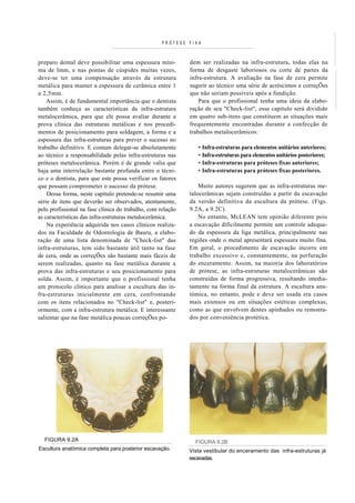 PRÓTESE FIXA



preparo dental deve possibilitar uma espessura míni-         dem ser realizadas na infra-estrutura, todas elas na
ma de lmm, e nas pontas de cúspides muitas vezes,            forma de desgaste laboriosos ou corte de partes da
deve-se ter uma compensação através da estrutura             infra-estrutura. A avaliação na fase de cera permite
metálica para manter a espessura de cerâmica entre 1         sugerir ao técnico uma série de acréscimos e correçÕes
a 2,5mm.                                                     que não seriam possíveis após a fundição.
    Assim, é de fundamental importância que o dentista           Para que o profissional tenha uma ideia da elabo-
também conheça as características da infra-estrutura         ração de seu "Check-list", esse capítulo será dividido
metalocerâmica, para que ele possa avaliar durante a         em quatro sub-itens que constituem as situações mais
prova clínica das estruturas metálicas e nos procedi-        frequentemente encontradas durante a confecção de
mentos de posicionamento para soldagem, a forma e a          trabalhos metalocerâmicos:
espessura das infra-estruturas para prever o sucesso no
trabalho definitivo. E comum delegar-se absolutamente           • Infra-estruturas para elementos unitários anteriores;
ao técnico a responsabilidade pelas infra-estruturas nas        • Infra-estruturas para elementos unitários posteriores;
próteses metalocerâmica. Porém é de grande valia que            • Infra-estruturas para próteses fixas anteriores;
haja uma interrelação bastante profunda entre o técni-          • Infra-estruturas para próteses fixas posteriores.
co e o dentista, para que este possa verificar os fatores
que possam comprometer o sucesso da prótese.                     Muito autores sugerem que as infra-estruturas me-
    Dessa forma, neste capítulo pretende-se resumir uma      talocerâmicas sejam construídas a partir da escavação
série de itens que deverão ser observados, atentamente,      da versão definitiva da escultura da prótese. (Figs.
pelo profissional na fase clínica do trabalho, com relação   9.2A, a 9.2C).
as características das infra-estruturas metalocerâmica.          No entanto, McLEAN tem opinião diferente pois
    Na experiência adquirida nos casos clínicos realiza-     a escavação dificilmente permite um controle adequa-
dos na Faculdade de Odontologia de Bauru, a elabo-           do da espessura da liga metálica, principalmente nas
ração de uma lista denominada de "Check-list" das            regiões onde o metal apresentará espessura muito fina.
infra-estruturas, tem sido bastante útil tanto na fase       Em geral, o procedimento de escavação incorre em
de cera, onde as correçÕes são bastante mais fáceis de       trabalho excessivo e, constantemente, na perfuração
serem realizadas, quanto na fase metálica durante a          do enceramento. Assim, na maioria dos laboratórios
prova das infra-estruturas e seu posicionamento para         de prótese, as infra-estruturas metalocerâmicas são
solda. Assim, é importante que o profissional tenha          construídas de forma progressiva, resultando imedia-
um protocolo clínico para analisar a escultura das in-       tamente na forma final da estrutura. A escultura ana-
fra-estruturas inicialmente em cera, confrontando            tómica, no entanto, pode e deve ser usada era casos
com os itens relacionados no "Check-list" e, posteri-        mais extensos ou em situações estéticas complexas,
ormente, com a infra-estrutura metálica. E interessante      como as que envolvem dentes apinhados ou remonta-
salientar que na fase metálica poucas correçÕes po-          dos por conveniência protética.




  FIGURA 9.2A                                                  FIGURA 9.2B
Escultura anatómica completa para posterior escavação.       Vista vestibular do enceramento das infra-estruturas já
                                                             escavadas.
 