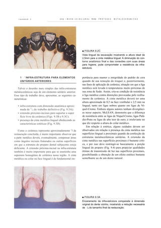 r u K IVI A 3   t                     U Ab   I IN h K A - h S I K U I U K A b   PA KA   P R Ó T E S E S   M E T A L O C E R A M I C A S




                                                                       ■ FIGURA 9.2C
                                                                       Vista lingual da escavação mostrando a altura ideal de
                                                                       2,5mm para a cinta metálica lingual. A diminuição do con-
                                                                       torno anatómico final e das conexões com suas áreas
                                                                       para higiene, pode comprometer a resistência da infra-
                                                                       estrutura.


     1 ' INFRA-ESTRUTURA PARA ELEMENTOS                                portância para manter a integridade do padrão de cera
     UNITÁRIOS ANTERIORES                                              quando de sua remoção do troquei e, posteriormente,
                                                                       nas fases de aplicação da cerâmica, situação em que a liga
    Talvez o desenho mais simples das infra-estruturas                 metálica será levada à temperaturas muito próximas de
metalocerâmicas seja de um elemento unitário anterior.                 sua zona de fusão. Assim, cria-se condição de resistência
Esse tipo de trabalho deve, apresentar, as seguintes ca-               à liga metálica contra distorções provocadas pelo resfria-
racterísticas:                                                         mento da cerâmica. A cinta metálica deverá ter uma
                                                                       altura aproximada de 0,5 na face vestibular e 2,5 mm na
   • infra-estrutura com dimensão anatómica aproxi                     lingual, tanto em ligas nobres quanto em ligas de Ní-
     mada de 2/3 do trabalho definitivo (Fig. 9.3A);                   quel-Cromo. Embora alguns autores tenham divergênci-
   • extensão proximo-incisais para suportar a super                   as nesse aspecto, McLEAN, demonstra que a diferença
     fície livre da cerâmica (Figs. 9.3B e 9.3C);                      de resistência entre as ligas de Níquel-Cromo, ligas Palá-
   • presença da cinta metálica lingual obedecendo as                  dio-Prata ou ligas de alto teor de ouro, é irrelevante no
     características estéticas (Fig. 9.3D).                            que diz respeito a altura do colar metálico.
                                                                           Em relação à estética, alguns cuidados devem ser
   Como a cerâmica representa aproximadamente xl da                    observados em relação à presença da cinta metálica nas
restauração concluída, é muito importante observar que                 superfícies lingual e proximais quando da confecção de
a parte metálica deverá, eventualmente, compensar áreas                estruturas metalocerâmicas unitárias. A extensão da
como ângulos incisais fraturados ou outras superfícies                 cinta metálica nas superfícies proximais é bastante críti-
em que a estrutura do preparo dental subjacente esteja                 ca, e por isso deve restringir-se basicamente a porção
deficiente. A extensão próximo-incisal na infra-estrutura              lingual do preparo (Fig. 9.4) para propiciar qualidades
também é muito importante para que se mantenha uma                     ótimas de transmissão de luz nas superfícies proximais,
espessura homogénea de cerâmica nessa região. A cinta                  possibilitando a obtenção de um efeito estético bastante
metálica ou colar na face lingual é de fundamental im-                 semelhante ao de um dente natural.




                                                                       ■ FIGURA 9.3A
                                                                       Enceramento da infra-estrutura comparada à dimensão
                                                                       original do dente vizinho, mostrando a redução necessária
                                                                       de /3 do tamanho final da restauração.
 