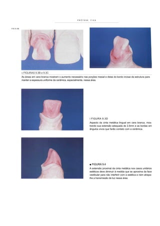 PRÓTESE    FIXA




FIG 9.3B




           « FIGURAS 9.3B e 9.3C
           As áreas em cera branca mostram o aumento necessário nas porções mesial e distai do bordo incisai da estrutura para
           manter a espessura uniforme da cerâmica, especialmente, nessa área.




                                                                        i FIGURA 9.3D
                                                                        Aspecto da cinta metálica lingual em cera branca, mos-
                                                                        trando sua extensão adequada de 2,5mm e as bordas em
                                                                        ângulos vivos que farão contato com a cerâmica.




                                                                       ■ FIGURA 9.4
                                                                        A extensão proximal da cinta metálica nos casos unitários
                                                                        estéticos deve diminuir à medida que se aproxima da face
                                                                        vestibular para não interferir com a estética e nem atrapa-
                                                                        lhe a transmissão de luz nessa área.
 
