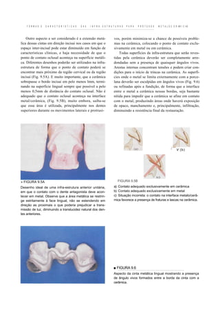 F O R M A S   E   C A R A C T E R Í S T I C A S   D A S   I N F R A - E S T R U T U R A S   P A R A   P R Ó T E S E S   M E T A L O C E R AM I C AS



    Outro aspecto a ser considerado é a extensão metá-                              vos, porém minimiza-se a chance de possíveis proble-
lica dessas cintas em direção incisai nos casos em que o                            mas na cerâmica, colocando o ponto de contato exclu-
espaço inter-incisal pode estar diminuído em função de                              sivamente em metal ou em cerâmica.
características clínicas, e haja necessidade de que o                                   Todas superfícies da infra-estrutura que serão reves-
ponto de contato oclusal aconteça na superfície metáli-                             tidas pela cerâmica deverão ser completamente arre-
ca. Diferentes desenhos poderão ser utilizados na infra-                            dondadas sem a presença de quaisquer ângulos vivos.
estrutura de forma que o ponto de contato poderá se                                 Arestas internas concentram tensões e podem criar con-
encontrar mais próximo da região cervical ou da região                              dições para o início de trincas na cerâmica. As superfí-
incisai (Fig. 9.5A). E muito importante, que a cerâmica                             cies onde o metal se limita externamente com a porce-
sobrepasse o bordo incisai em pelo menos lmm, termi-                                lana deverão ser esculpidas em ângulos vivos (Fig. 9.6)
nando na superfície lingual sempre que possível a pelo                              ou refinadas após a fundição, de forma que a interface
menos 0,5mm de distância do contato oclusal. Não é                                  entre o metal a cerâmica nessas bordas, seja bastante
adequado que o contato oclusal aconteça na interface                                nítida para impedir que a cerâmica se afine em contato
metal/cerâmica, (Fig. 9.5B), muito embora, saiba-se                                 com o metal, produzindo áreas onde haverá exposição
que essa área é utilizada, principalmente nos dentes                                de opaco, manchamento e, principalmente, infiltração,
superiores durante os movimentos laterais e protrusi-                               diminuindo a resistência final da restauração.




                                                                                                                                       '    V (b)




» FIGURA 9.5A                                                                           FIGURA 9.5B
Desenho ideal de uma infra-estrutura anterior unitária,                             a) Contato adequado exclusivamente em cerâmica
em que o contato com o dente antagonista deve acon-                                 b) Contato adequado exclusivamente em metal
tecer em metal. Observe que a área metálica se restrin-                             c) Situação incorreta: o contato na interface metalo/cerâ-
ge estritamente à face lingual, não se estendendo em                                mica favorece a presença de fraturas e lascas na cerâmica.
direção as proximais o que poderia prejudicar a trans-
missão de luz, diminuindo a translucidez natural dos den-
tes anteriores.




                                                                                    ■ FIGURA 9.6
                                                                                    Aspecto da cinta metálica lingual mostrando a presença
                                                                                    de ângulo vivos formados entre a borda da cinta com a
                                                                                    cerâmica.
 