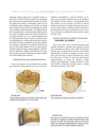 F O R M A S E   C A R A C T E R Í S T I C A S   DAS   I N F R A - E S T R U T U R A S   P A R A   P R Ó T E S E S   M E T A L O C E R Â M I C A S



superiores, obriga confeccionar a superfície oclusal ou                            trabalhos metaloplásticos. Convém salientar, no en-
parte dela em metal. Diversas opções de configuração                               tanto, que essa janela vestibular deverá ser expulsiva,
para infra-estrutura metalocerâmica poderão ser utiliza-                           seus ângulos internos obtusos e arrendondados deve-
das quando isso acontece. É interessante, então levar em                           rão terminar, no nível oclusal, no mínimo a lmm de
consideração alguns princípios que deverão ser usados                              distância das pontas de cúspides funcionais para que o
para a criação das mais diferentes combinações de acordo                           contato oclusal sobre as cúspides metálicas não provo-
com a situação oclusal apresentada. A semelhança do que                            que flexão do metal que, eventuamente, levará a trin-
já foi comentado para as infra-estruturas unitárias anteri-                        ca ou até mesmo à expulsão da faceta estética vestibu-
ores, todos os ângulos externos de contato do metal com                            lar (Fig. 9.8A).
a cerâmica deverão ser vivos e, aproximadamente em
90°. Diferentemente do que se pratica nas facetas estéti-                              I B) FACE VESTIBULAR E CÚSPIDES VESTIBULARES
cas metaloplásticas, a cerâmica não deverá ficar restrita a                                 CONSTRUÍDAS EM CERÂMICA
uma janela escavada na superfície da estrutura metálica.
Isso contraria os princípios de resistência mecânica des-                              Nesse caso toda a face vestibular passando pela
critos no início desse capítulo. Por isso, as áreas especifi-                      cúspide vestibular e entrando pela superfície oclusal
camente carentes de espaço oclusal poderão ser substitu-                           será construída em cerâmica. (Fig. 9.8B). É importante
ídas por superfícies metálicas. Normalmente três situa-                            salientar que a cerâmica deverá invadir a face oclusal,
ções ocorrem com maior frequência que exigem superfí-                              ultrapassando as pontas de cúspides em pelo menos
cie oclusal metálica total ou parcial:                                             lmm, para que haja a ação de abraçamento e apoio,
                                                                                   de forma que as linhas de força que atravessarem
     A) SUPERFÍCIE OCLUSAL CONSTRUÍDA EM METAL                                     tangencialmente as pontas de cúspides, criando
                                                                                   esforços de cizalhamento e tração, encontrem o subs-
   Nesse caso somente a face vestibular será revestida                             trato metálico subjacente provendo apoio e amparo
por cerâmica de forma parecida com o que se usa nos                                mecânico à cerâmica. (Fig. 9.8C).




                                                             METAL                                                                                METAL




                                                          cr.RAMK                                                                              CEIIAMK


  FIGURA 9.8A                                                                     5§ FIGURA 9.8B
.Faceta estética vestibular em cerâmica. A área externa das                        Face vestibular e cúspides funcionais em cerâmica.
cúspides funcionais deve ter I mm de metal

                                   1




                                                                                      FIGURA 9.8C
                                                                                  Nos casos de recobrimento parcial da superfície oclusal
                                                                                  em metal, as cúspides em cerâmica deverão invadir a face
                                                                                  oclusal I mm além de suas pontas, para que as linha de
                                                                                  forças que atravessam tangencialmente as pontas de cús-
                                                                                  pides encontrem um suporte metálico subjacente.
 