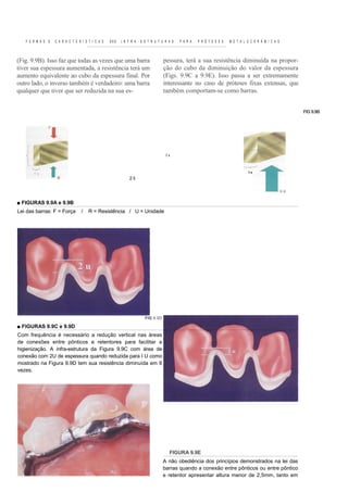 F O R M A S E   C A R A C T E R Í S T I C A S   DAS   I N F R A - E S T R U T U R A S   P A R A   P R Ó T E S E S   M E T A L O C E R Â M I C A S



(Fig. 9.9B). Isso faz que todas as vezes que uma barra                            pessura, terá a sua resistência diminuída na propor-
tiver sua espessura aumentada, a resistência terá um                              ção do cubo da diminuição do valor da espessura
aumento equivalente ao cubo da espessura final. Por                               (Figs. 9.9C a 9.9E). Isso passa a ser extremamente
outro lado, o inverso também é verdadeiro: uma barra                              interessante no caso de próteses fixas extensas, que
qualquer que tiver que ser reduzida na sua es-                                    também comportam-se como barras.


                                                                                                                                                       FIG 9.9B




                                                                                   Iu



                                                                                                                                 1u
                                                             2 li




■ FIGURAS 9.9A e 9.9B
Lei das barras: F = Força         /    R = Resistência / U = Unidade




                                                                       FIG 9.9D

■ FIGURAS 9.9C e 9.9D
Com frequência é necessário a redução vertical nas áreas
de conexões entre pônticos e retentores para facilitar a
higienização. A infra-estrutura da Figura 9.9C com área de
conexão com 2U de espessura quando reduzida para I U como
mostrado na Figura 9.9D tem sua resistência diminuída em 8
vezes.




                                                                                     FIGURA 9.9E
                                                                                  A não obediência dos princípios demonstrados na lei das
                                                                                  barras quando a conexão entre pônticos ou entre pôntico
                                                                                  e retentor apresentar altura menor de 2,5mm, tanto em
 
