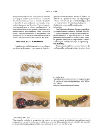 PRÓTESE   FIXA



das superfícies vestibulares dos retentores e suas dimensões   apresentadas anteriormente. Assim, os pônticoj rão
inciso-gengival tambe'm sejam proporcionais as dimensões       submetidos a grandes esforços em função cargas
dos elementos retentores. Todos os elementos deverão ter       oclusais consideráveis que acorrem na re| posterior
as dimensões de aproximadamente 2/ do tamanho corres-          e as características dessa infra-estruti devem
pondente à anatomia final da prótese. Um erro frequente-       obedecer ao mesmo padrão das descritas
mente cometido com as próteses metalocerâmicas é a             teriormente.
construção de pônticos com tamanho reduzido por eco-               Os pônticos deverão ter sua forma correspondent
nomia de metal, o que resultará num volume excessivo de        forma anatómica da restauração finalizada reduzida
cerâmica com prejuízo mecânico e, principalmente, com          V4, para que haja espaço adequado para a colocação i
alteração de cor, em função de uma espessura maior de          cerâmica inclusive na superfície gengival, de forma
cerâmica nos pônticos do que nos retentores. (Fig. 9.13)       permitir um suave contato da cerâmica com o rebord
                                                               ou apresentar uma distância adequada entre a cerâmic e
     PRÓTESES FIXAS POSTERIORES                                o rebordo para facilitar a realização da higiene (Figí
                                                               9.l4Ae9.l4B).
  Nos elementos múltiplos posteriores os esforços                  As conexões dos pônticos com os retentores sãc
mecânicos serão maiores entre todas as situações               confeccionadas nas faces proximais de ambos. Os re-




                                                               li FIGURA 9.13
                                                               a) Configuração incorreta da estrutura metálica do pônti-
                                                               co. A espessura excessiva da cerâmica cria riscos mecâni
                                                               co e estético.
                                                               b) Forma correta da estrutura metálica




  FIGURAS 9.I4A e 9.I4B
Vistas oclusal e vestibular de uma prótese fixa posterior em cera, mostrando a redução de /4 dos pônticos, quando
comparado com o retentor molar que será totalmente em metal. Observa-se também as extensões das conexões
proximais no sentido oclusal para torná-las mais resistentes, de acordo com a lei das barras.
 