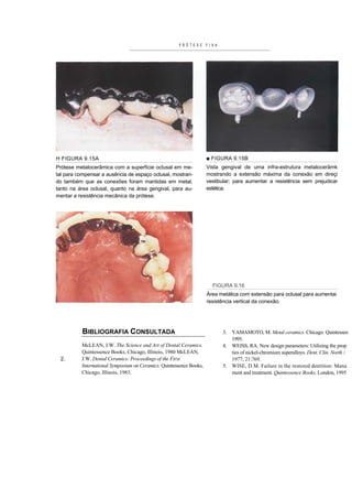 PRÓTESE F I X A




H FIGURA 9.15A                                                       ■ FIGURA 9.15B
Prótese metalocerâmica com a superfície oclusal em me-               Vista gengival de uma infra-estrutura metalocerâmk
tal para compensar a ausência de espaço oclusal, mostran-            mostrando a extensão máxima da conexão em direçi
do também que as conexões foram mantidas em metal,                   vestibular; para aumentar a resistência sem prejudicar
tanto na área oclusal, quanto na área gengival, para au-             estética.
mentar a resistência mecânica da prótese.




                                                                       FIGURA 9.16
                                                                     Área metálica com extensão para oclusal para aumentai
                                                                     resistência vertical da conexão.




           BIBLIOGRAFIA CONSULTADA                                         3. YAMAMOTO, M. Metal ceramics. Chicago. Quintessen
                                                                              1995.
          McLEAN, J.W. The Science and Art of Dental Ceramics.             4. WEISS, RA. New design parameters: Utilizing the prop
          Quintessence Books, Chicago, Illinois, 1980 McLEAN,                 ties of nickel-chromium superalloys. Dent. Clin. North /.
 2.       J.W. Dental Ceramics: Proceedings of the First                      1977; 21:769.
          International Symposium on Ceramics. Quintessence Books,         5. WISE, D.M. Failure in the restored dentition: Mana
          Chicago, Illinois, 1983.                                            ment and treatment. Quintessence Books, London, 1995
 
