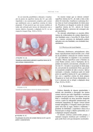 PRÓTESE   F I X A



   Ao ser removida, possibilitam a detecção e visualiza-              Ao mesmo tempo que se detecta contatoí
ção de pontos da superfície interna das I.E. que estão            superfície interna da I.E., de onde a tinta evide
impedindo o seu assentamento completo, pelo contato               adora foi removida, visualiza-se a presença da r
que estabelecem com as superfícies externas do dente              ma tinta no local correspondente do dente prep
preparado. É bem possível que este recurso também já              do. Procede-se ao desgaste no ponto de contat(
tenha sido utilizado pelo técnico de laboratório com o            superfície interna da I.E., através de brocas
mesmo objetivo, buscando a adaptação da I.E. no seu               mantadas. Repetir o processo até conseguir ada
respectivo troquei (Figs. 10.IA a 10.1C).                         ção satisfatória.
                                                                      No mercado odontológico se encontra difere
                                                                  marcas de evidenciadores de contato disponíveis j
                                                                  esta finalidade como o Accu-film IV, Kota, Occli
                                                                  etc, e mesmo corretores de datilografia podem
                                                                  aplicados com esta finalidade, com resultados bast;
                                                                  satisfatórios.

                                                                            1.2. PELÍCULA DE ELASTÔMERO

                                                                      Diferentes elastômeros, principalmente silicc
                                                                  foram especificamente desenvolvidas com a final
                                                                  de de possibilitar a detecção de contatos internos
«FIGURA 10. IA                                                    I.E. que dificultam ou impedem o seu assentame
Substância evidenciadora aplicada à superfície interna de I.E.    completo. Marcas específicas como o Ramitec ou
para prótese metalocerâmica.                                      conas fluidas comuns, como o Xantopren, são m;
                                                                  pulados de maneira convencional, colocados no h
                                                                  rior das I.E. e levados à sua posição no dente prep;
                                                                  do, com pressão de assentamento firme, que possil
                                                                  te escoamento completo de todo o excesso. Após p
                                                                  merização e remoção, visualiza-se parte do metal
                                                                  posto na superfície interna da I.E. que estabelece c
                                                                  tato com a superfície externa do dente prepara
                                                                  Desgasta-se no local com brocas diamantadas e re
                                                                  te-se o processo até se atingir a adaptação desej
                                                                  (Figs. 10.2A a 10.2C).

                                                                            1 . 5 . RADIOGRAFIAS
   FIGURA 10.1B
Substância evidenciadora visível nos dentes preparados.               Embora disponha de alguma popularidade, t
                                                                  método não possibilita a percepção dos pontos
                                                                  contato internos que estão impedindo o assentame
                                                                  completo da peça protética. Com alguma sorte po
                                                                  bilita a visualização de áreas proximais desajustac
                                                                  visíveis a partir de radiografias interproximais, ma
                                                                  totalmente dependente do ângulo vertical durant
                                                                  tomada radiográfica. O desgaste interno para busca
                                                                  ajuste seria feito às cegas, intuitivo e totalmente <
                                                                  pendente da habilidade e experiência clínica do p
                                                                  fissional para se atingir o objetivo primordial, ou s<
                                                                  a adaptação marginal adequada.
                                                                       O método continua controvertido porque, [
■ FIGURA 10. IC
                                                                  superpor margens metálicas por vestibular e 1
Visualização de pontos de contato internos na I.E. que im-
                                                                  gual, pode fazer com que desajustes acentuados
pedem o assentamento
 