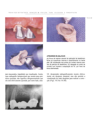 P R O V A   D O S   R E T E N T O R E S ,   R E M O Ç Ã O   EM   P O S I Ç Ã O   P A R A   S O L D A G E M   E   R E M O N T A C E M



                                                                                                                                                FIG.I0.2B




                                                                                 «FIGURAS IO.2Aa I0.2C
                                                                                 (A) Prova de retentor através da aplicação de elastômero
                                                                                 fluído as superfícies internas e assentamento no dente
                                                                                 pilar; (B) visualização dos pontos de contato internos atra-
                                                                                 vés da película de elastômero; (C) desgaste do ponto de
                                                                                 contato que impede a adaptação da I.E. por meio de
                                                                                 broca diamantada.


jam mascarados, impedindo sua visualização. Assim,                               I.E. desajustada radiograficamente mostra efetiva-
uma radiografia interproximal que mostra peça pro-                               mente um desajuste marginal, mas não permite a
tética ajustada, não significa obrigatoriamente que                              visualização de onde desgastar para realizar a corre -
ela está efetivamente ajustada; por outro lado, uma                              ção (Figs. 10.3Ae 10.3B).
 