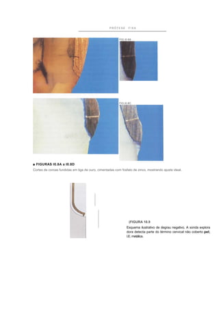 PRÓTESE       FIXA



                                                         FIG.I0.8A




                                                         FIG.I0.8C




■ FIGURAS I0.8A a I0.8D
Cortes de coroas fundidas em liga de ouro, cimentadas com fosfato de zinco, mostrando ajuste ideal.




                                                                (FIGURA 10.9
                                                              Esquema ilustrativo de degrau negativo. A sonda explora
                                                              dora detecta parte do término cervical não coberto pel;
                                                              I.E. metálica.
 