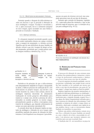 PRÓTESE   FIXA



      5 . 2 . 2 . REPETIÇÃO DA MOLDAGEM E TROOUEL          apenas em parte do término cervical, mas uma
                                                           pode apresentar mais de um tipo de desajuste.
    Somente quando o desgaste da infra-estrutura re-           Somente após correção de desajustes, repetiçãc
sulta em fracasso é que se procede à obtenção de           I.E. e aprovação plena dos retentores, é que se pas
nova moldagem e troquei. Esculpe-se novamente a            próxima etapa do processo, que é a remoção em p
I.E. e, após escavação, faz-se o selamento marginal        çao para soldagem (Fig. 10.12).
no novo troquei, agora recortado nos seus limites e
procede-se à inclusão e fundição.

      5 . 5 . ESPAÇO CERVICAL

    E o desajuste marginal encontrado quando a pon-
ta da sonda exploradora detecta um espaço existente
entre a margem da restauração e o término cervical.
Significa que há uma deficiência da peça fundida em
direção vertical e que ela é incapaz de atingir as bor-
das preparadas, permitindo que a sonda penetre entre
as margens metálica e dentária (Fig. 10.11).

                                                           ■ FIGURA 10.12
                                                           Prova dos retentores de reabilitação oral através de p
                                                           tese metalocerâmica




                                                                  4. REMOÇÃO EM POSIÇÃO PARA
                                    c                             SOLDAGEM
■ FIGURA 10.11
Esquema ilustrativo de           desajuste. A ponta da         O processo de obtenção de uma estrutura meta
sonda     desliza   em           direção ao espaço         de prótese fixa metalocerâmica é minucioso, criteri»
existente    entre    a          margem      da    res-    e exige do profissional conhecimentos e dedica»
tauração e o término cervical.                             para levar a bom termo este tipo de trabalho.
                                                               O uso de materiais de primeira qualidade, com téc
    Partindo-se do princípio de que a infra-estrutura      cas precisas e sofisticadas, nem sempre levam a um tra
está adequadamente adaptada no troquei e desajustada       lho bem sucedido se for realizado por técnico poi
no dente, a falha no processo de confecção da I.E. está    afeito a este tipo de procedimento, que gosta de "qi
efetivamente no próprio troquei, seja devido a um          mar etapas" e chegar mais rápido ao final do trabalh<
recorte incorreto ou, como é mais comum, através da            Registros imprecisos das posições intermaxilares, te
moldagem imprecisa decorrente do afastamento               po aquém do ideal para polimerizaçao ou cristalização <
inadequado do tecido gengival, dificuldades para           diferentes materiais, ciclo de aquecimento de revestime]
manter-se o campo seco, devido a presença de saliva,       insuficiente para a expansão desejada, troqueis fixos, e
transudato ou exudato gengival, ou mesmo sangue,           são alguns dos fatores frequentemente utilizados para a
                                                           lerar o processo de obtenção das infra-estruturas. Comf
principalmente quando se utiliza a mercaptana como
                                                           mentando as tentativas de reduzir o tempo clínico ou
material de moldagem, que depende sobremaneira de
                                                           laboratório, objetivando a produção mais rápida da est
campo seco para apresentar reprodução fiel.
                                                           tura metálica, tem-se o que se convencionou chamar
    A correção desse tipo de desajuste implica na repe-
                                                           fundição em monobloco ou peça única.
tição da moldagem e obtenção de novo troquei, para
                                                               Embora seja prática relativamente comum em p
possibilitar repetição dos passos de obtenção da infra-
                                                           tese fixa, a obtenção de peças fundidas em monob
estrutura. Com frequência esse desajuste é percebido       co, com o objetivo de evitar a necessidade de sol<
                                                           gem, é um processo que incorpora inúmeros erro
                                                           contribui para um mau resultado final.
                                                               A fundição das I.E. em monobloco ou peça ún
 
