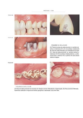 PRÓTESE      FIXA



FIG.I0.I3A




FIG.I0.I3C




                                                                                FIGURAS I 0.I3A a I0.I3C
                                                                             (A) Fratura de área de solda proximal, no sentido ver
                                                                             entre os retentores 22 e 23, de prótese metalocerâi
                                                                             (B) Área de solda fraturada, por insuficiência de super
                                                                             (C) Área de solda proximal, no sentido vertical, e
                                                                             retentores 43-44 de prótese metalocerâmica; a união
                                                                             ximal entre o retentor 44 e o pôntico 45 será atravé
                                                                             solda em degrau.



FIG.I0.I4A




               FIGURAS I0.I4A e I0.I4B
             (A) Área de solda proximal com excesso em direção cervical, dificultando a higienização; (B) Área proximal inflamada,
             hipertrofia vestibular e lingual dos tecidos gengivais e depressão (col) entre eles.
 