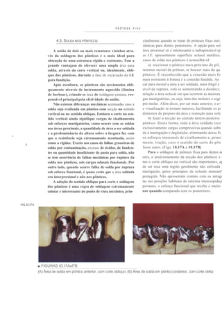 PRÓTESE    FIXA



                            4.5. SOLDA NOS PÔNTICOS                                 cipalmente quando se tratar de próteses fixas met;
                                                                                    râmicas para dentes posteriores. A opção para sol
                          A união de dois ou mais retentores vizinhos atra-         área proximal só é interessante e indispensável qt
                      vés da soldagem dos pônticos é o meio ideal para              as I.E. apresentarem superfície oclusal metálica.
                      obtenção de uma estrutura rígida e resistente. Tem a          casos de solda nos pônticos é aconselhável:
                      grande vantagem de oferecer uma ampla área para                   a) seccionar o pôntico mais próximo do pil;
                      solda, através do corte vertical ou, idealmente, oblí-        retentor mesial da prótese, se houver mais do qu
                      quo dos pônticos, durante a fase de escavação da I.E          pôntico. É reconhecido que a conexão mais fo
                      para fundição.                                                mais resistente à fratura é a conexão fundida. Ao
                          Após escultura, os pônticos são seccionados obli-         car para mesial a área a ser soldada, mais frágil e
                      quamente através de instrumento aquecido (lâmina              sível de ruptura, está se aumentando a distânci;
                      de barbear), criando-se área de soldagem extensa, res-        relação a área oclusal em que ocorrem as maiores
                      ponsável principal pela efetividade da união.                 gas mastigatórias, ou seja, área dos molares e segi
                          Não existem diferenças mecânicas acentuadas caso a        pré-molar. Além disso, por ser mais anterior, o a<
                      solda seja realizada em pôntico com secção no sentido         e visualização se tornam maiores, facilitando os pi
                      vertical ou no sentido oblíquo. Embora o corte no sen-        dimentos de preparo da área e remoção para sole
                      tido vertical ainda signifique cargas de cisalhamento             b) fazer a secção no sentido ântero-posterio
                      sob esforços mastigatórios, como ocorre com as soldas         pôntico. Desta forma, toda a área soldada rece
                      nas áreas proximais, a quantidade de área a ser soldada       exclusivamente cargas compressivas quando subn
                      e a predominância da altura sobre a largura faz com           da à mastigação e deglutição, eliminando dessa fo
I
                      que a resistência seja extremamente acentuada, assim          os esforços tensionais de cisalhamento e, princi
                      como a rigidez. Exceto nos casos de falhas grosseiras de      mente, tração, caso o sentido do corte do pôn
       i
                      solda por contaminação, excesso de óxidos, de funden-         fosse outro. (Figs. 10.17A e 10.17B)
                      tes ou quantidade insuficiente de pasta para solda, não           Para a soldagem de próteses fixas para dentes an
                      se tem ocorrência de falhas mecânicas por ruptura da          ores, o posicionamento da secção dos pônticos e r
                      solda nos pônticos, sob cargas odusais funcionais. Por        mo o corte oblíquo ou vertical são importantes, ap
                      outro lado, quando ocorre falha de solda por ruptura          de ser essa uma região geralmente não utilizada ]
                      sob esforço funcional, é quase certo que a área soldada       mastigação, pelos princípios da oclusão mutuam*
                      era interproximal e não nos pônticos.                         protegida. Não apresentam contato com os antago
                          A adoção do sentido oblíquo para corte e soldagem         tas nas posições habituais de máxima intercuspidaçã
                      dos pônticos é uma regra de soldagem extremamente             portanto, o esforço funcional que recebe é muito i
                      salutar e interessante do ponto de vista mecânico, prin-      nor quando comparado com os posteriores.


    HG.I0.I7A




                ■ FIGURAS IO.I7Ael7B
                (A) Área de solda em pôntico anterior; com corte oblíquo; (B) Área de solda em pôntico posterior, com corte oblíqi
 